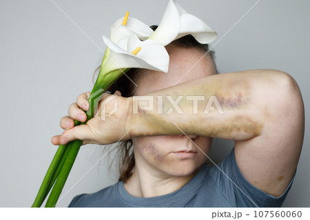 Woman hiding her face her hands with issues bruise and flowers. Domestic violence and abuse  107560060