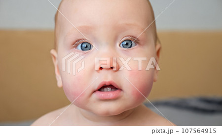 Baby girl with allergic reaction on cheeks looks with surprise 107564915