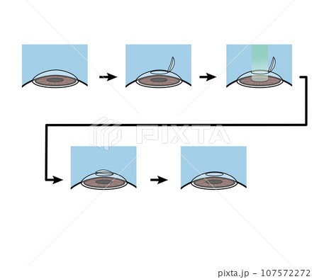 レーシック手術 107572272