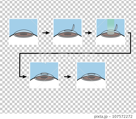 レーシック手術 107572272