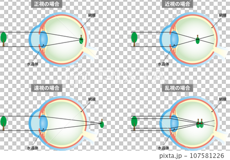 正視、近視、遠視、散光、眼睛結構、附文字 正視、近視、遠視、散光、眼睛結構、附文字 107581226