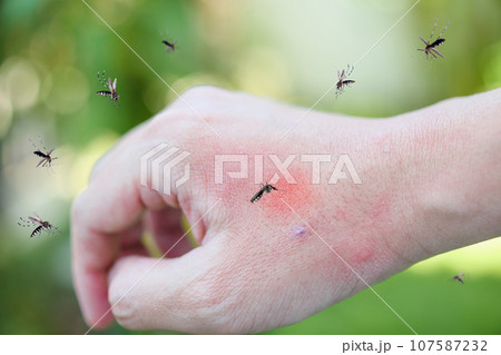 Mosquitoes bite on adult hand made skin rash and allergy with red spot Mosquitoes bite on adult hand made skin rash and allergy with red spot 107587232