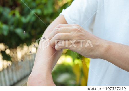 Man itching and scratching on arm from allergy skin rash cause by Mosquitoes bite Man itching and scratching on arm from allergy skin rash cause by Mosquitoes bite 107587240