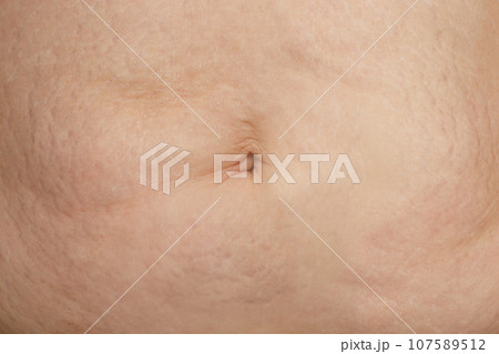 Stretch mark on female skin, belly closeup 107589512