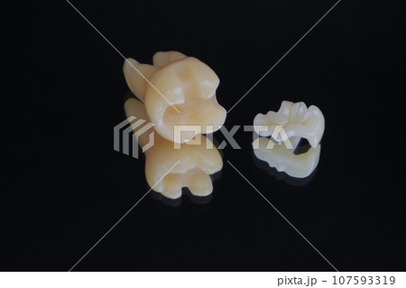 下顎大臼歯セラミックインレー 下顎大臼歯セラミックインレー 107593319