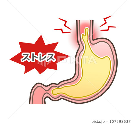 胃食道逆流症のイラスト 胃食道逆流症のイラスト 107598637