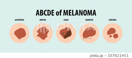 Illustrated Guide to Five Types of Skin Cancer 107621451