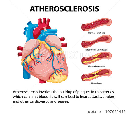 Science Education: Human Anatomy and Atherosclerosis Infographic 107621452