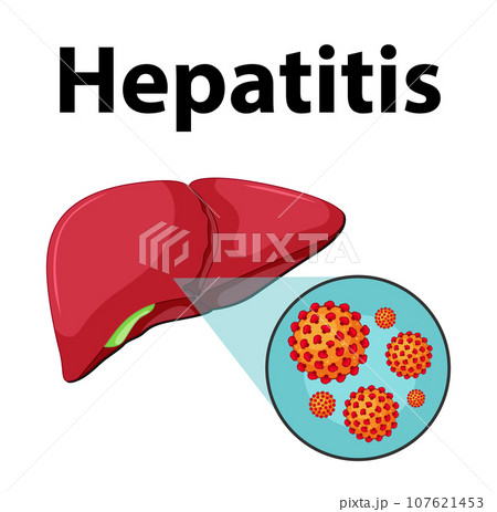 Close-Up of Hepatitis Virus Cell on Human Liver Anatomy 107621453