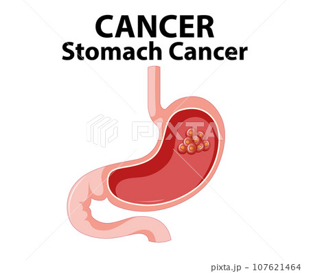 Illustrated Infographic of Stomach Cancer Anatomy Illustrated Infographic of Stomach Cancer Anatomy 107621464