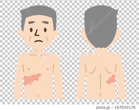 Shingles symptoms illustration Shingles symptoms illustration 107650176