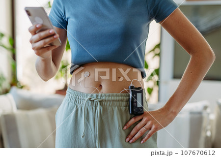 Close up of diabetic woman with insulin pump. Young woman with diabetes at home. Close up of diabetic woman with insulin pump. Young woman with diabetes at home. 107670612