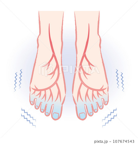 末端冷え性 血流の悪い冷えた足先のイラスト 末端冷え性 血流の悪い冷えた足先のイラスト 107674543