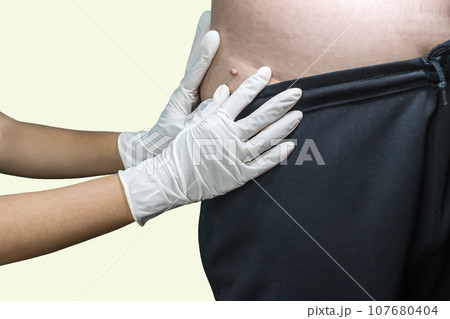 Skin tag or acrochondon or soft fibroma Skin tag or acrochondon or soft fibroma 107680404