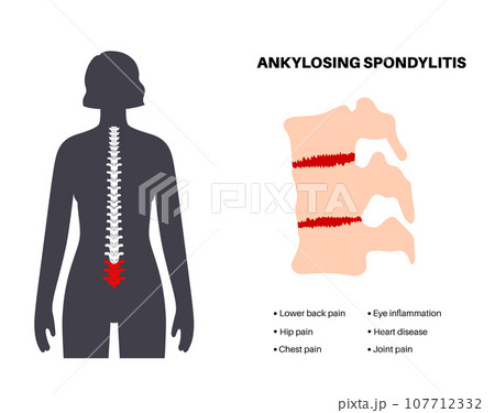 Ankylosing spondylitis disease Ankylosing spondylitis disease 107712332
