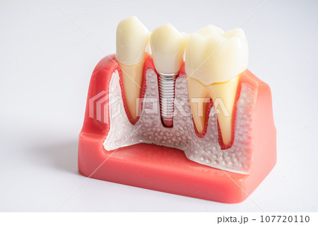 Dental implant, artificial tooth roots into jaw, root canal of dental treatment, gum disease, teeth model for dentist studying about dentistry. 107720110