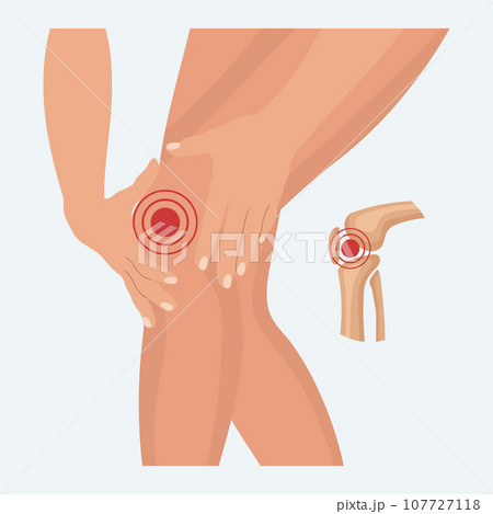 Pain in the knee joint, knee arthritis, leg pain due to rheumatoid arthritis. Anatomy of human bones. Illustration, vector 107727118