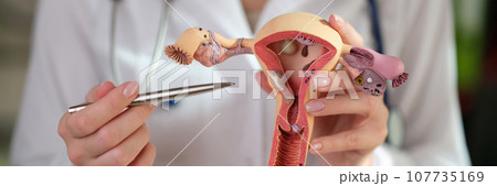 Gynecologist points pen to model of uterus and ovaries Gynecologist points pen to model of uterus and ovaries 107735169