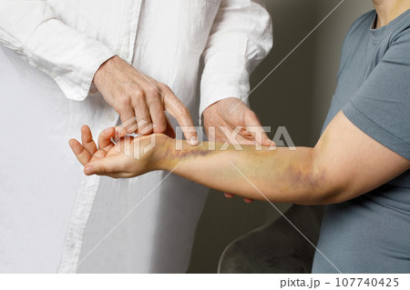 Doctor examining bruises on her patient's arm. Medicine and treatment concept Doctor examining bruises on her patient's arm. Medicine and treatment concept 107740425