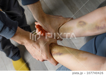 Domestic violence and abuse concept. Male hand and female hand with bruise at home 107740426