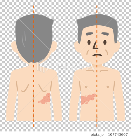 Shingles symptoms illustration 107743607