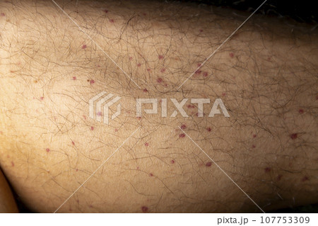 Vasculitis. Vasculitis in legs. Small red or purple spots. Post covid syndrome due to an immunological reaction of the body. Grain. Inflammation of the blood vessels. Rare disease. Photography. 107753309