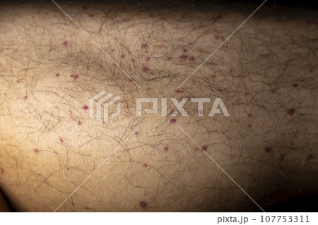 Vasculitis. Vasculitis in legs. Small red or purple spots. Post covid syndrome due to an immunological reaction of the body. Grain. Inflammation of the blood vessels. Rare disease. Photography. 107753311