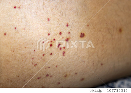 Vasculitis. Vasculitis in legs. Small red or purple spots. Post covid syndrome due to an immunological reaction of the body. Grain. Inflammation of the blood vessels. Rare disease. Photography. Vasculitis. Vasculitis in legs. Small red or purple spots. Post covid syndrome due to an immunological reaction of the body. Grain. Inflammation of the blood vessels. Rare disease. Photography. 107753313