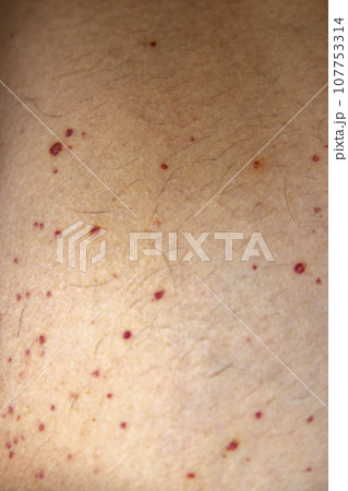 Vasculitis. Vasculitis in legs. Small red or purple spots. Post covid syndrome due to an immunological reaction of the body. Grain. Inflammation of the blood vessels. Rare disease. Photography. Vasculitis. Vasculitis in legs. Small red or purple spots. Post covid syndrome due to an immunological reaction of the body. Grain. Inflammation of the blood vessels. Rare disease. Photography. 107753314