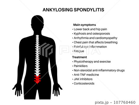 Ankylosing spondylitis disease Ankylosing spondylitis disease 107768460