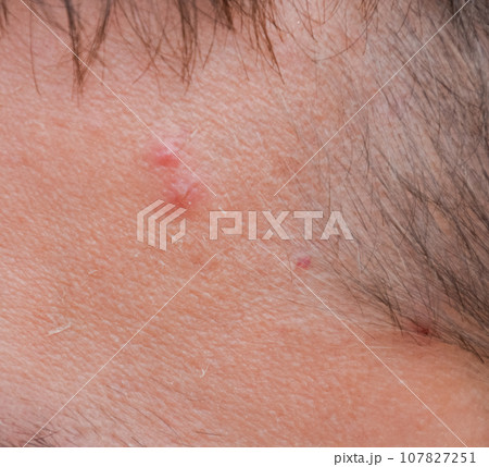 Pimples on the forehead of man. Acne on the forehead Pimples on the forehead of man. Acne on the forehead 107827251