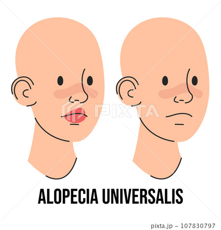 Alopecia universalis vector isolated. Two characters Alopecia universalis vector isolated. Two characters 107830797