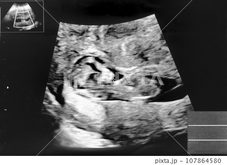 妊娠して11週目の胎児のエコー写真 107864580