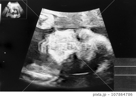 妊娠して26週目の胎児のエコー写真 妊娠して26週目の胎児のエコー写真 107864786