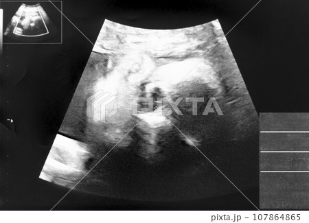 妊娠して30週目の胎児のエコー写真 107864865