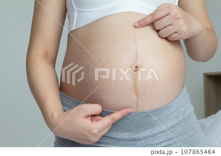 Close up of linea nigra and stretch marks on pregnant women in the last trimester of pregnancy Close up of linea nigra and stretch marks on pregnant women in the last trimester of pregnancy 107865464