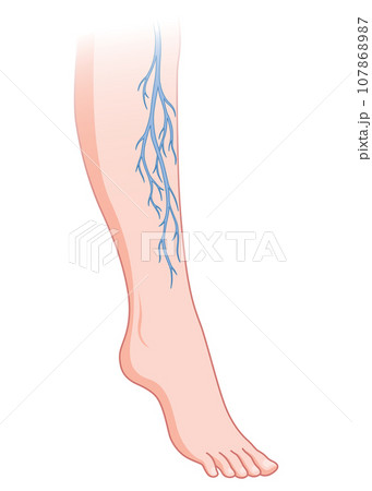 Varicose veins. Blue blood vessel visible through the skin, abnormally swollen leg. Vascular disease diagnostic and treatment. Venous insufficiency medical disease 107868987