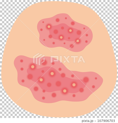 Skin with red eczema Skin disease Medical care 107906703