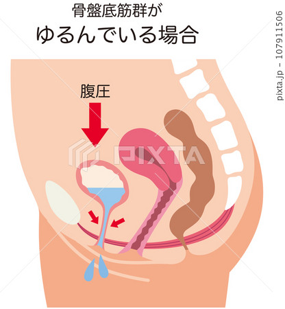 ゆるんでいる骨盤底筋と排尿の仕組み 尿もれ 健康 ゆるんでいる骨盤底筋と排尿の仕組み 尿もれ 健康 107911506
