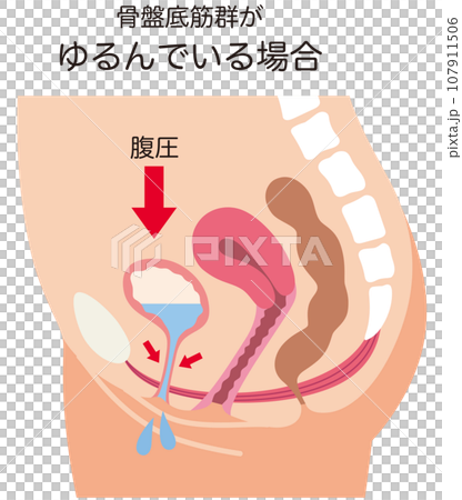ゆるんでいる骨盤底筋と排尿の仕組み 尿もれ 健康 ゆるんでいる骨盤底筋と排尿の仕組み 尿もれ 健康 107911506