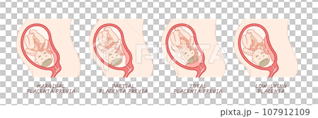 前置胎盤 前置胎盤 插圖 前置胎盤 前置胎盤 插圖 107912109