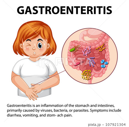Chubby Woman with Gastroenteritis: Symptoms Infographic Chubby Woman with Gastroenteritis: Symptoms Infographic 107921304