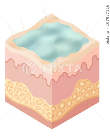 Protection uv ray skin. Illustration about Skin care concept. Sun protection body adipose layers epidermis, vector infographic 107937316