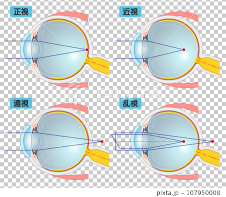 Illustrations/eye/illustration of eyeballs, myopia, farsightedness, presbyopia, and astigmatism 107950008