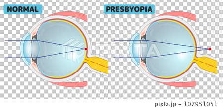 Eyeball, myopia, farsightedness, presbyopia, presbyopia, astigmatism, illustration/eye/illustration 107951051