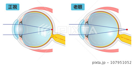眼球、近視、遠視、老眼、presbyopia、乱視、イラスト・eye・illustration 眼球、近視、遠視、老眼、presbyopia、乱視、イラスト・eye・illustration 107951052