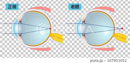 眼球、近視、遠視、老眼、presbyopia、乱視、イラスト・eye・illustration 眼球、近視、遠視、老眼、presbyopia、乱視、イラスト・eye・illustration 107951052