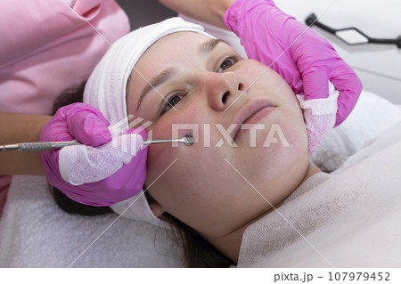 Beautician Cleaning Face Skin Of Young Girl With Uno Spoon, Steel Appliance From Acne. Blackhead Remover Tool. Mechanical Facial Cleansing Treatment, Procedure At Beauty Salon. Cosmetology, Skincare. Beautician Cleaning Face Skin Of Young Girl With Uno Spoon, Steel Appliance From Acne. Blackhead Remover Tool. Mechanical Facial Cleansing Treatment, Procedure At Beauty Salon. Cosmetology, Skincare. 107979452