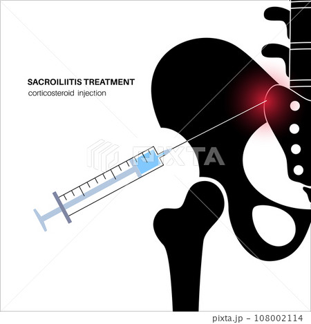 Sacroiliitis corticosteroid injections Sacroiliitis corticosteroid injections 108002114