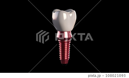 Dental implant isolated on black background. 3d illustration Dental implant isolated on black background. 3d illustration 108021093